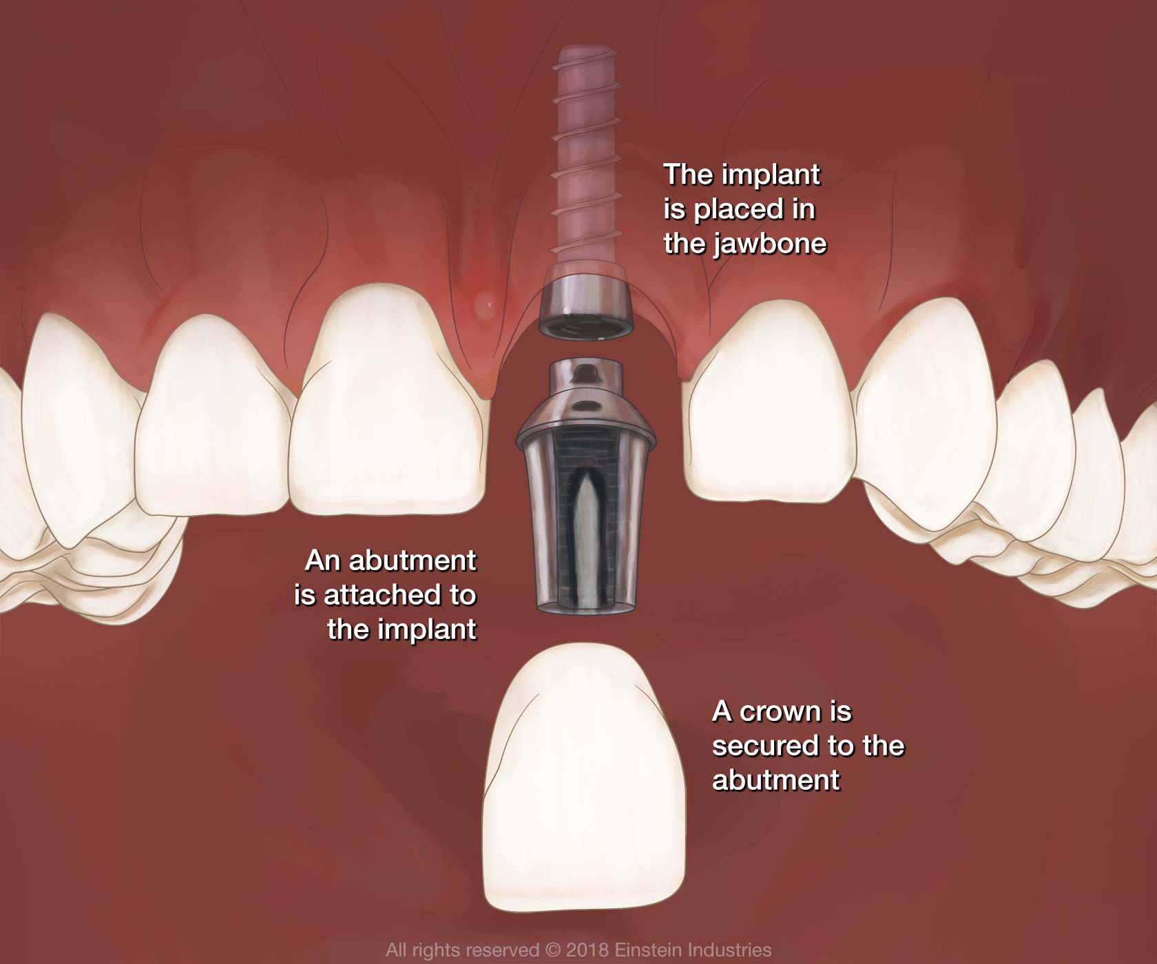 Illustration of jaw and dental implant